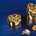 Why is gold used in dentistry? Dental crowns - what are they? 